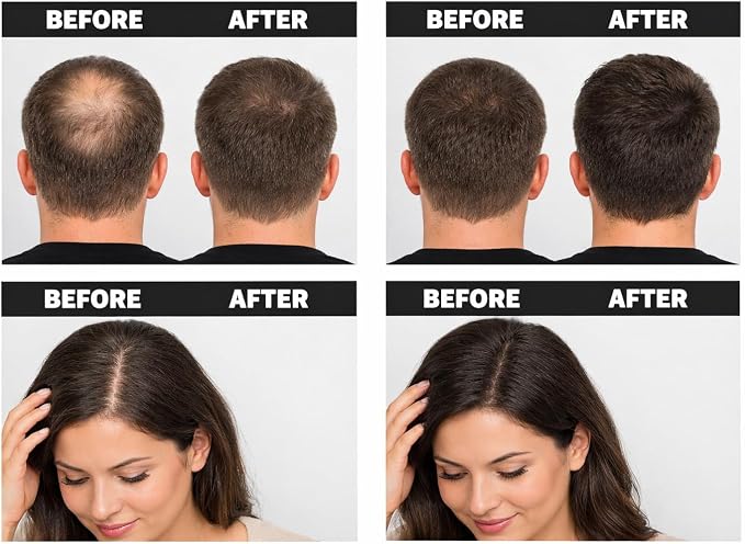 A four-panel before-and-after comparison collage showing hair growth results. The top row shows the back of a man's head with thinning hair, and the bottom row shows a woman looking down with thinning hair.