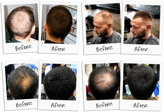 A collage of eight before-and-after hair photos showing men from the back and side, demonstrating the results of a hair loss or thinning treatment. The photos are arranged in a 2x4 grid with handwritten labels 'Before' and 'After' under each photo.