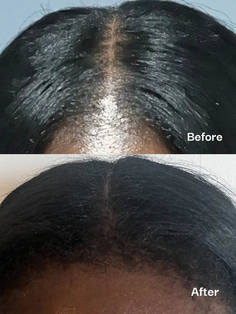 Before and after comparison of hair treatment on a person's scalp.