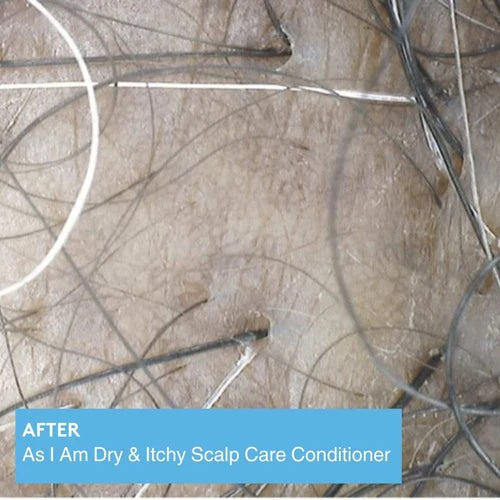 Scalp with dry and itchy patches and hair strands, labeled 'After' with product name.