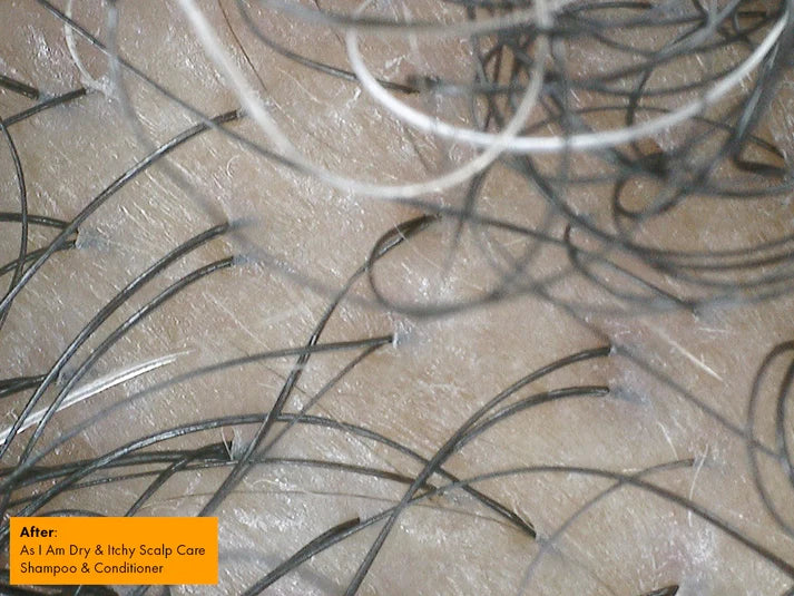 Scalp with dry and itchy skin showing clumps of hair, labeled 'After' for a scalp care product.