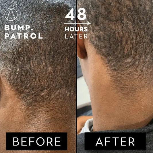 Bump Patrol - Aftershave Treatment Original Formula